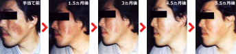 左頬全体の黒いシミと凹みの傷痕が肌が回復して解消
